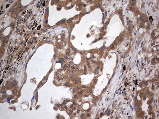 ARAF / ARAF1 / A-RAF Antibody - IHC of paraffin-embedded Carcinoma of Human lung tissue using anti-ARAF mouse monoclonal antibody. (Heat-induced epitope retrieval by 1 mM EDTA in 10mM Tris, pH8.5, 120°C for 3min).