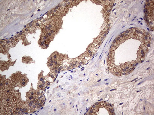 ARAF / ARAF1 / A-RAF Antibody - IHC of paraffin-embedded Carcinoma of Human prostate tissue using anti-ARAF mouse monoclonal antibody. (Heat-induced epitope retrieval by 1 mM EDTA in 10mM Tris, pH8.5, 120°C for 3min).