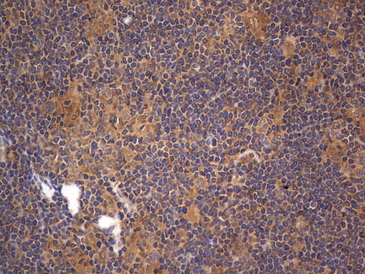 ARAF / ARAF1 / A-RAF Antibody - IHC of paraffin-embedded Human lymphoma tissue using anti-ARAF mouse monoclonal antibody. (Heat-induced epitope retrieval by 1 mM EDTA in 10mM Tris, pH8.5, 120°C for 3min).