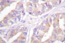 ARAF / ARAF1 / A-RAF Antibody - IHC of A-RAF (D297) pAb in paraffin-embedded human breast carcinoma tissue.