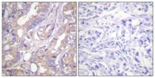 ARAF / ARAF1 / A-RAF Antibody - Peptide - + Immunohistochemistry analysis of paraffin-embedded human breast carcinoma tissue using A-RAF (Ab-301/302) antibody.