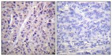 ARAF / ARAF1 / A-RAF Antibody - Immunohistochemistry analysis of paraffin-embedded human breast carcinoma, using A-RAF (Phospho-Tyr302) Antibody. The picture on the right is blocked with the phospho peptide.