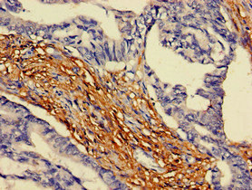 ARAP3 Antibody - Immunohistochemistry of paraffin-embedded human colon cancer at dilution of 1:100