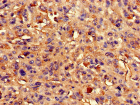 ARAP3 Antibody - Immunohistochemistry of paraffin-embedded human melanoma cancer at dilution of 1:100