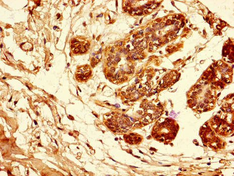 AREG / Amphiregulin Antibody - Immunohistochemistry of paraffin-embedded human breast cancer tissue using AREG Antibody at dilution of 1:100
