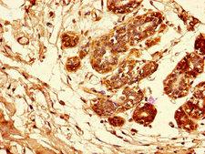 AREG / Amphiregulin Antibody - Immunohistochemistry of paraffin-embedded human breast cancer tissue using AREG Antibody at dilution of 1:100