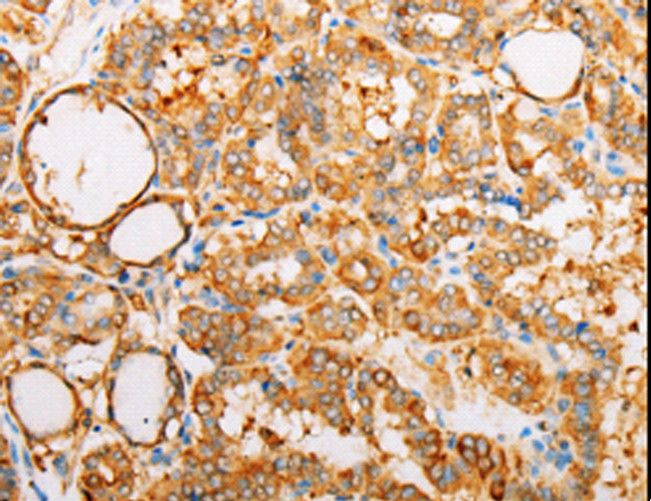 ARF1 Antibody - Immunohistochemistry of paraffin-embedded Human thyroid cancer using ARF1 Polyclonal Antibody at dilution of 1:25.