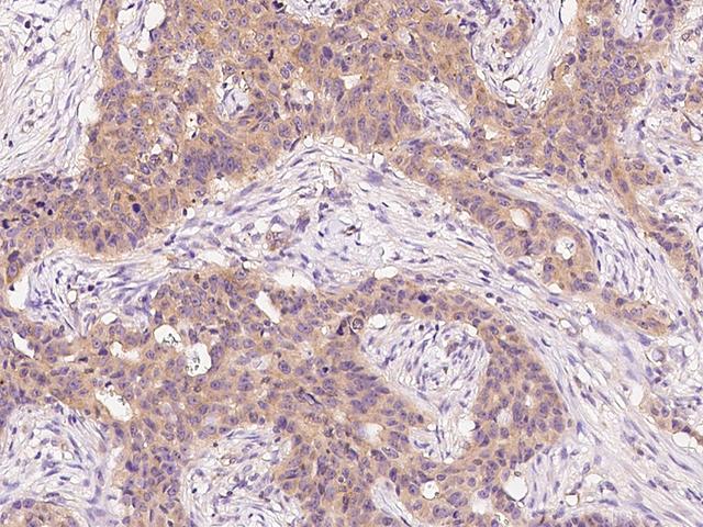 ARF3 Antibody - Immunochemical staining ARF3 in human breast carcinoma with rabbit polyclonal antibody at 1:300 dilution, formalin-fixed paraffin embedded sections.