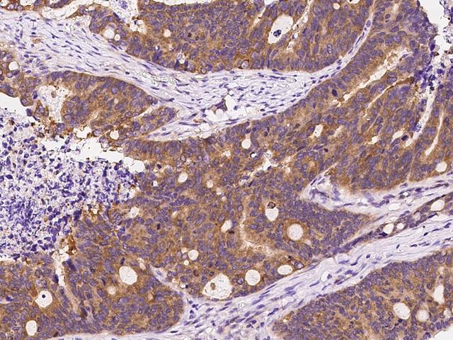 ARF3 Antibody - Immunochemical staining ARF3 in human colon carcinoma with rabbit polyclonal antibody at 1:300 dilution, formalin-fixed paraffin embedded sections.