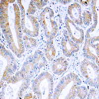 ARF4 Antibody - Immunohistochemical analysis of ARF4 staining in human colon cancer formalin fixed paraffin embedded tissue section. The section was pre-treated using heat mediated antigen retrieval with sodium citrate buffer (pH 6.0). The section was then incubated with the antibody at room temperature and detected using an HRP conjugated compact polymer system. DAB was used as the chromogen. The section was then counterstained with hematoxylin and mounted with DPX.