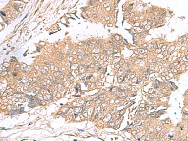 ARF5 Antibody - Immunohistochemistry of paraffin-embedded Human colorectal cancer tissue  using ARF5 Polyclonal Antibody at dilution of 1:40(×200)