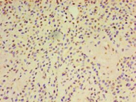 ARF6 Antibody - Immunohistochemistry of paraffin-embedded human breast cancer using antibody at 1:100 dilution.  This image was taken for the unconjugated form of this product. Other forms have not been tested.
