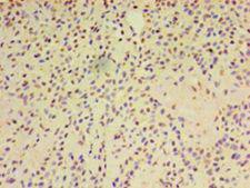 ARF6 Antibody - Immunohistochemistry of paraffin-embedded human breast cancer using antibody at 1:100 dilution.  This image was taken for the unconjugated form of this product. Other forms have not been tested.
