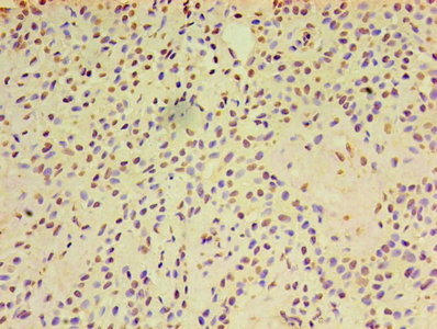 ARF6 Antibody - Immunohistochemistry of paraffin-embedded human breast cancer using ARF6 Antibody at dilution of 1:100