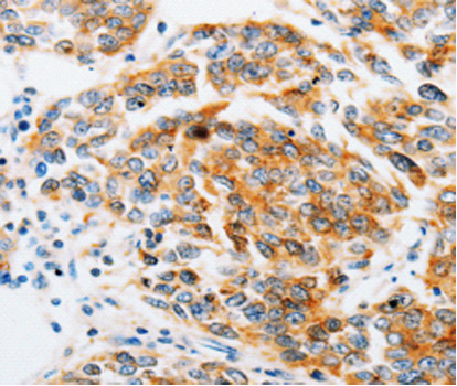 ARF6 Antibody - Immunohistochemistry of paraffin-embedded human breast cancer tissue using ARF6 antibody.