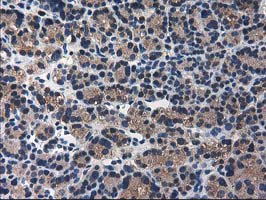 ARFGAP1 Antibody - IHC of paraffin-embedded Carcinoma of Human thyroid tissue using anti-ARFGAP1 mouse monoclonal antibody.