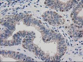 ARFGAP1 Antibody - IHC of paraffin-embedded Adenocarcinoma of Human endometrium tissue using anti-ARFGAP1 mouse monoclonal antibody.