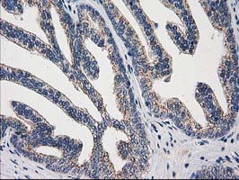 ARFGAP1 Antibody - IHC of paraffin-embedded Carcinoma of Human prostate tissue using anti-ARFGAP1 mouse monoclonal antibody.