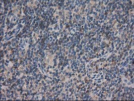 ARFGAP1 Antibody - IHC of paraffin-embedded Human lymphoma tissue using anti-ARFGAP1 mouse monoclonal antibody.