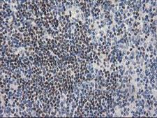 ARFGAP1 Antibody - IHC of paraffin-embedded Human lymphoma tissue using anti-ARFGAP1 mouse monoclonal antibody.