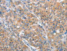 ARFGAP1 Antibody - Immunohistochemistry of paraffin-embedded Human lung cancer using ARFGAP1 Polyclonal Antibody at dilution of 1:30.