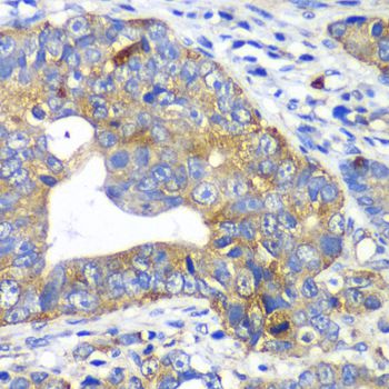 ARFGAP1 Antibody - Immunohistochemistry of paraffin-embedded human gastric cancer using ARFGAP1 antibody at dilution of 1:100 (40x lens).
