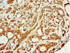 ARFGAP3 Antibody - Immunohistochemistry of paraffin-embedded human breast cancer using antibody at 1:100 dilution.