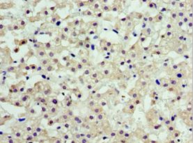 ARFGAP3 Antibody - Immunohistochemistry of paraffin-embedded human liver cancer using antibody at 1:100 dilution.
