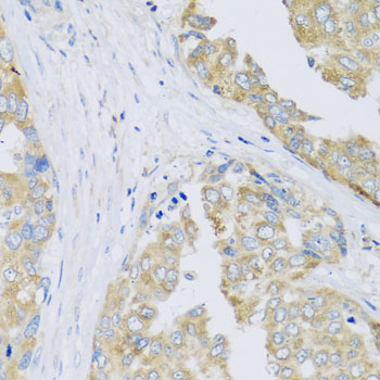ARFGAP3 Antibody - Immunohistochemistry of paraffin-embedded human liver cancer tissue.