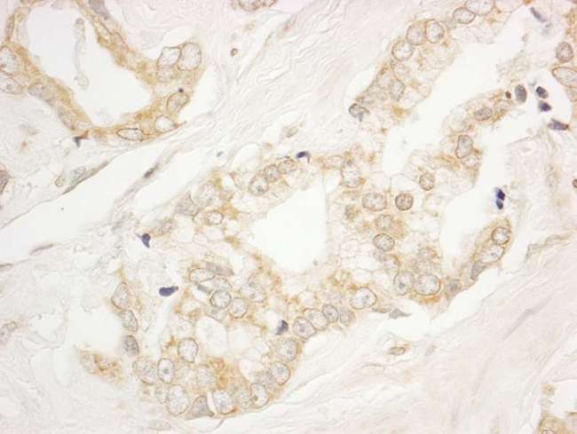 ARFGEF1 Antibody - Detection of Human BIG1/ARFGEF1 by Immunohistochemistry. Sample: FFPE section of human prostate carcinoma. Antibody: Affinity purified rabbit anti-BIG1/ARFGEF1 used at a dilution of 1:1000 (1 ug/ml).