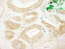 ARFGEF2 / BIG2 Antibody - Detection of Human BIG2/ARFGEF2 by Immunohistochemistry. Sample: FFPE section of human prostate carcinoma. Antibody: Affinity purified rabbit anti-BIG2/ARFGEF2 used at a dilution of 1:200 (1 ug/ml).