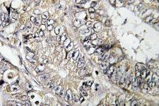 ARFGEF2 / BIG2 Antibody - IHC of BIG2 (L1527) pAb in paraffin-embedded human colon carcinoma tissue.