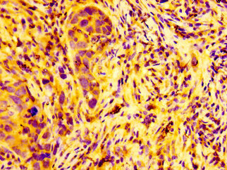 ARFGEF2 / BIG2 Antibody - Immunohistochemistry image at a dilution of 1:100 and staining in paraffin-embedded human pancreatic cancer performed on a Leica BondTM system. After dewaxing and hydration, antigen retrieval was mediated by high pressure in a citrate buffer (pH 6.0) . Section was blocked with 10% normal goat serum 30min at RT. Then primary antibody (1% BSA) was incubated at 4 °C overnight. The primary is detected by a biotinylated secondary antibody and visualized using an HRP conjugated SP system.