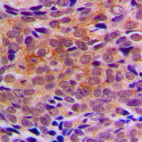 ARFIP1 Antibody - Immunohistochemical analysis of ARFIP1 staining in human breast cancer formalin fixed paraffin embedded tissue section. The section was pre-treated using heat mediated antigen retrieval with sodium citrate buffer (pH 6.0). The section was then incubated with the antibody at room temperature and detected using an HRP conjugated compact polymer system. DAB was used as the chromogen. The section was then counterstained with hematoxylin and mounted with DPX.