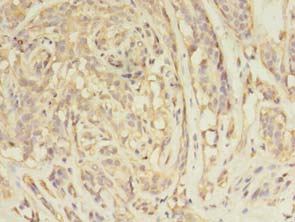 ARFIP2 / Arfaptin 2 Antibody - Immunohistochemistry of paraffin-embedded human breast cancer tissue using antibody at 1:100 dilution.