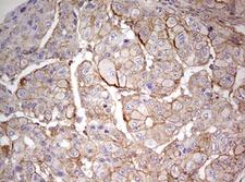 ARFL3 / ARL3 Antibody - IHC of paraffin-embedded Carcinoma of Human liver tissue using anti-ARL3 mouse monoclonal antibody. (Heat-induced epitope retrieval by 10mM citric buffer, pH6.0, 120°C for 3min).