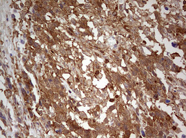 ARFL3 / ARL3 Antibody - IHC of paraffin-embedded Adenocarcinoma of Human ovary tissue using anti-ARL3 mouse monoclonal antibody. (Heat-induced epitope retrieval by 10mM citric buffer, pH6.0, 120°C for 3min).