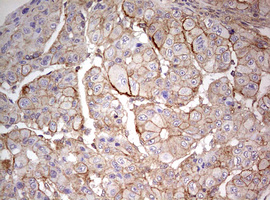 ARFL3 / ARL3 Antibody - IHC of paraffin-embedded Carcinoma of Human liver tissue using anti-ARL3 mouse monoclonal antibody. (Heat-induced epitope retrieval by 10mM citric buffer, pH6.0, 120°C for 3min).