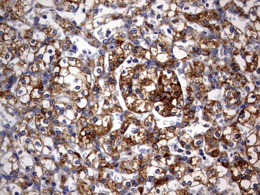 ARFL3 / ARL3 Antibody - IHC of paraffin-embedded Carcinoma of Human kidney tissue using anti-ARL3 mouse monoclonal antibody. (Heat-induced epitope retrieval by 10mM citric buffer, pH6.0, 120°C for 3min).
