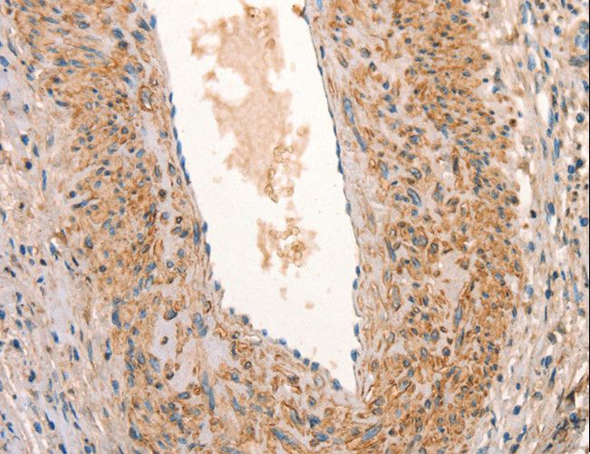 ARFRP1 Antibody - Immunohistochemistry of paraffin-embedded Human cervical cancer using ARFRP1 Polyclonal Antibody at dilution of 1:25.