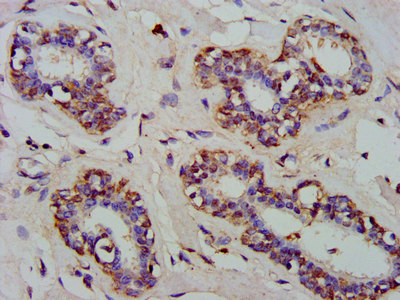 ARFRP1 Antibody - Immunohistochemistry image at a dilution of 1:300 and staining in paraffin-embedded human breast cancer performed on a Leica BondTM system. After dewaxing and hydration, antigen retrieval was mediated by high pressure in a citrate buffer (pH 6.0) . Section was blocked with 10% normal goat serum 30min at RT. Then primary antibody (1% BSA) was incubated at 4 °C overnight. The primary is detected by a biotinylated secondary antibody and visualized using an HRP conjugated SP system.