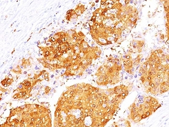 ARG1 / Arginase 1 Antibody - Formalin-fixed, paraffin-embedded human hepatocellular carcinoma stained with Arginase 1 antibody (ARG1/1125 + ARG1/1126).  This image was taken for the unmodified form of this product. Other forms have not been tested.