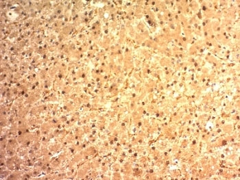 ARG1 / Arginase 1 Antibody - Formalin-fixed, paraffin-embedded human hepatocellular carcinoma stained with Arginase 1 antibody (ARG1/1125).  This image was taken for the unmodified form of this product. Other forms have not been tested.