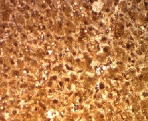 ARG1 / Arginase 1 Antibody - Formalin-fixed, paraffin-embedded human hepatocellular carcinoma stained with Arginase 1 antibody (ARG1/1126).  This image was taken for the unmodified form of this product. Other forms have not been tested.