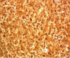 ARG1 / Arginase 1 Antibody - IHC testing of FFPE human hepatocellular carcinoma and Arginase 1 antibody (clone T1ARG-1).  This image was taken for the unmodified form of this product. Other forms have not been tested.