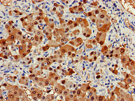 ARG1 / Arginase 1 Antibody - Immunohistochemistry of paraffin-embedded human liver cancer at dilution of 1:100