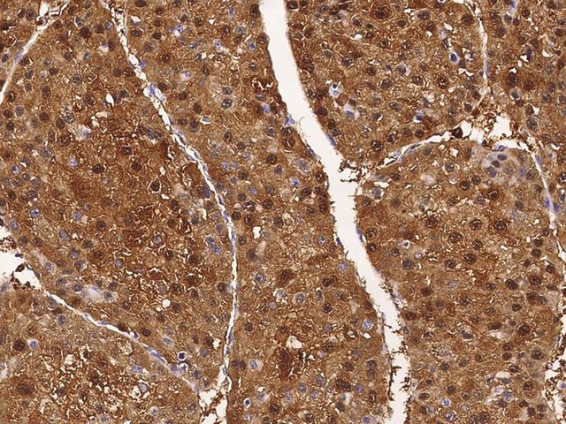 ARG1 / Arginase 1 Antibody - Immunochemical staining of human Arginase in human hepatoma with rabbit polyclonal antibody at 1:2000 dilution, formalin-fixed paraffin embedded sections.