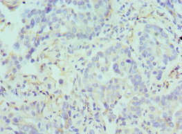 ARG2 / Arginase 2 Antibody - Immunohistochemistry of paraffin-embedded human lung cancer using ARG2 Antibody at dilution of 1:100