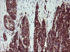 ARG2 / Arginase 2 Antibody - IHC of paraffin-embedded Adenocarcinoma of Human colon tissue using anti-ARG2 mouse monoclonal antibody. (Heat-induced epitope retrieval by 10mM citric buffer, pH6.0, 120°C for 3min).