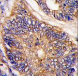 ARH / LDLRAP1 Antibody - Formalin-fixed and paraffin-embedded human colon carcinoma tissue reacted with LDLRAP1 antibody , which was peroxidase-conjugated to the secondary antibody, followed by DAB staining. This data demonstrates the use of this antibody for immunohistochemistry; clinical relevance has not been evaluated.